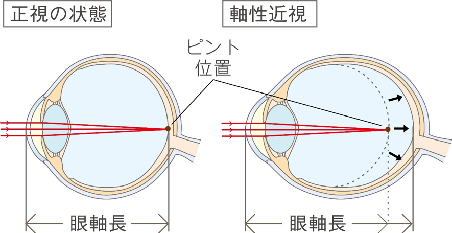 正視の状態と軸性近視の比較図